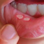 Are canker sores contagious? The mystery unveiled